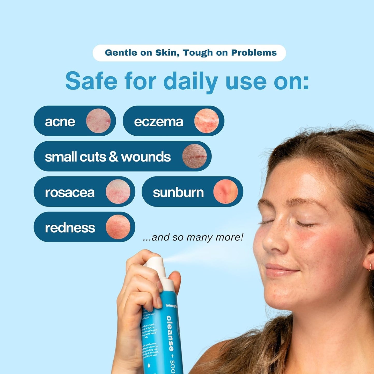 Hypochlorous Acid Spray – HOCl Face & Skin Mist for Acne, Eczema & Irritation – Multi-Purpose Skin Repair – Eyelid Cleanser, Post-Workout, Post-Procedure, Scalp & Sensitive Skin – 6.8 oz