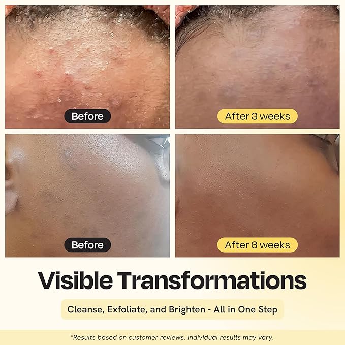 Gleamin Vitamin C Face Wash & Facial Cleanser - Cream to Foam 2% Salicylic Acid Cleanser with Paw Paw & Turmeric - Gentle Exfoliating Facewash for Women & Men, Oily & Combination Skin, 3.4 fl oz