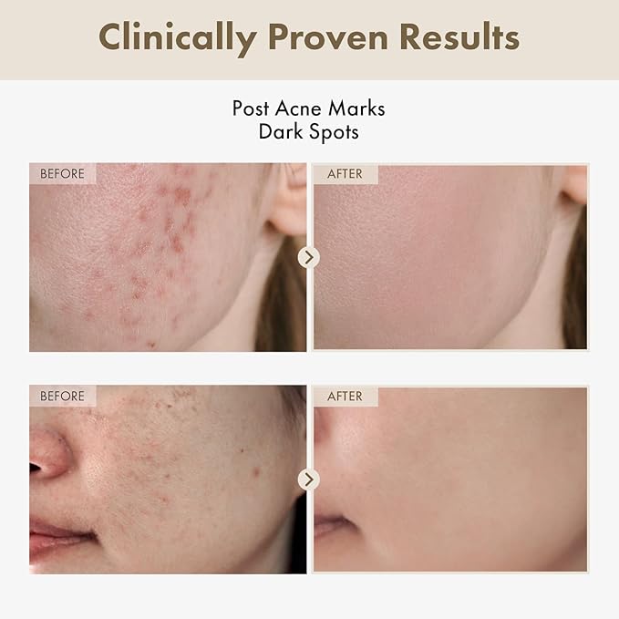 Alpha Arbutin 2% Rice Serum, Rice 746,074ppm, Alpha-Arbutin 20,000ppm, Glow, Glass skin, Pigmentation, Acne Marks, Dark Spots, Even Skin Tone, Hydrating, Korean Skin Care, 33ml / 1.11 fl.oz.