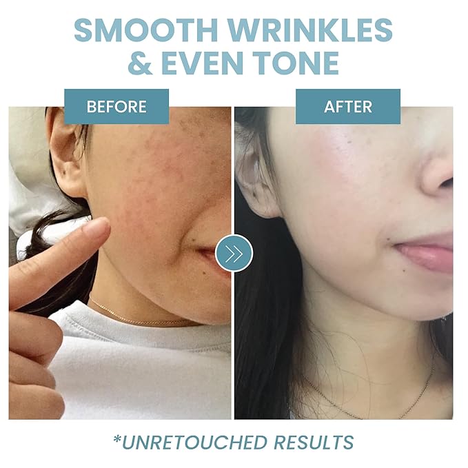 Collagen Peptide Serum for Face – Anti Aging Facial Treatment with Peptides & Hyaluronic Acid – Gentle for Sensitive Skin, Microneedling Pen, Derma Roller, Skin Firming & Hydrating (2 Oz) (2 Pack)