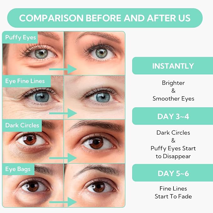 8X Hyaluronic Acid Under Eye Patches(30 Pairs) -Cooling Eye Masks for Deep Moisturizing, with Ectoin Niacinamide Hydra-Gel Collagen, Puffy Eyes Treatment, Fine Lines & Wrinkles Reduce