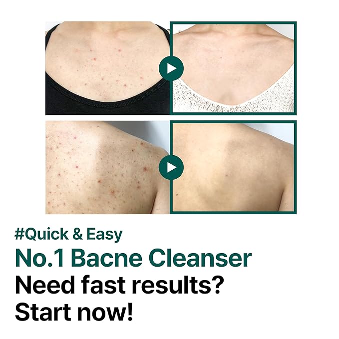 SOME BY MI AHA BHA PHA 30 Days Miracle Acne Clear Body Cleanser - Pack of 2 - Daily Exfoliating Tea Tree Acne Body Wash with Salicylic Acid - Deep Cleanses Sebum and Impurities - Korean Skin Care