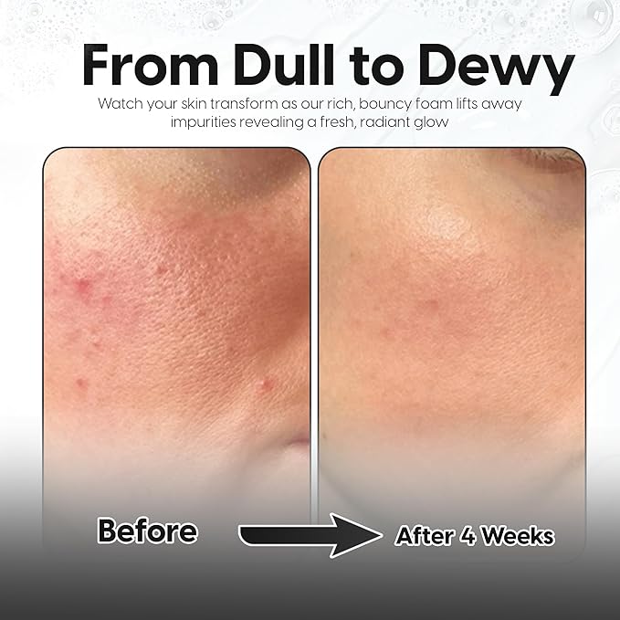 5% Lactic Acid + 2% Salicylic Acid Cleanser –Non-Stripping AHA/BHA Exfoliating Face & Body Wash With Ceramides. Minimizes Pores, Keratosis Pilaris, Acne, Ingrown Hairs & Psoriasis-200ml.